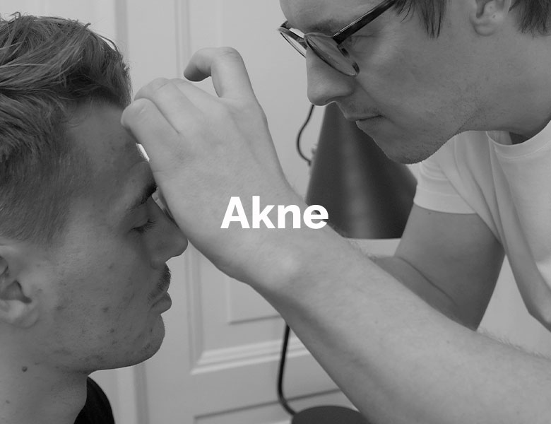 Nærbillede af hud med akne